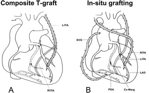 Routine Use of Bilateral Skeletonized Internal Thoracic Artery Grafting | Circulation