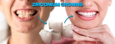 Zirconium Crowns before after