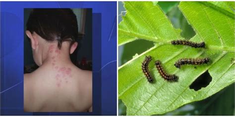 Gypsy Moth Caterpillars Are Causing Serious Skin Irritations - How to ...