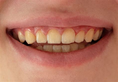 Why Are My Teeth Suddenly Turning Brown? (Causes, Prevention & Treatments)