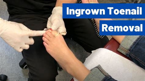 Ingrown Toenail Removal Surgery Video | Permanent, Cosmetic Procedure - YouTube