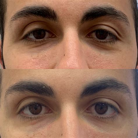 What’s the Best Way to Fix Tired-Looking Under Eyes? Botox