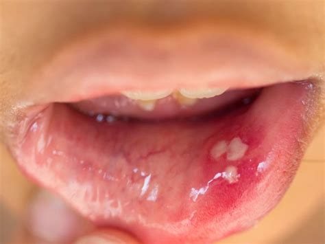 Hpv Corner Of Mouth