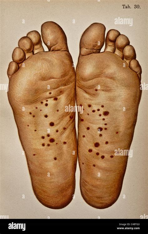 Syphilis rash hi-res stock photography and images - Alamy