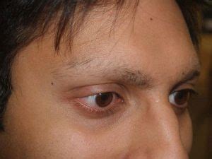 Madarosis – A Condition That Causes Hair Loss of Eyelashes and Eyebrows – RRMCH