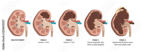 Kidney cancer stages Stock Vector | Adobe Stock