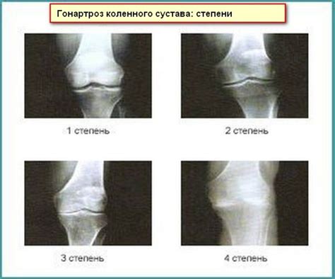 Gonartroza stawu kolanowego 2 stopnie: przyczyny i objawy choroby, leczenie i zapobieganie ...