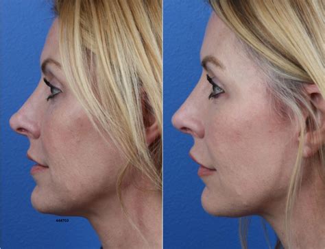 Endonasal Rhinoplasty - Philip Miller MD