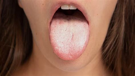 Why Does Your Tongue Suddenly Taste Sour, Expert Explains | OnlyMyHealth