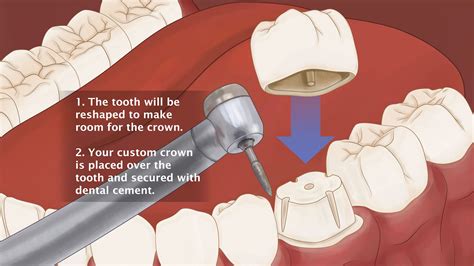 Dental Crowns Spring, TX - Tooth Crown - Stephens and Gatewood Dentistry