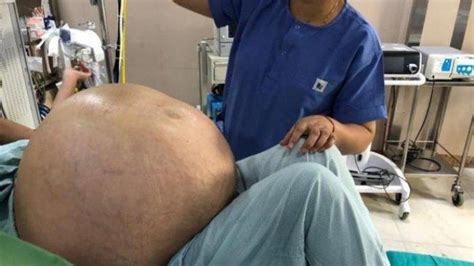 Tumor Ovarium Terbesar di Dunia Berhasil Diangkat Tim Medis, Berat Tumor Capai 50 Kilogram ...