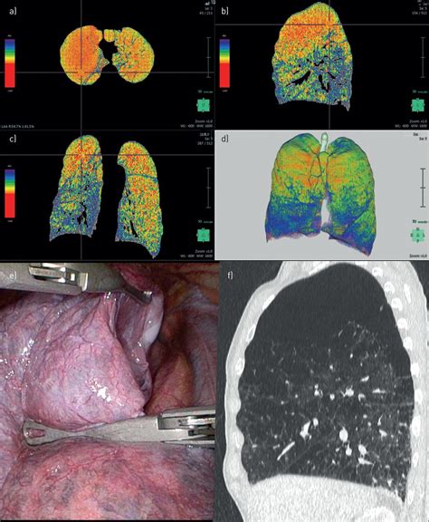 Identification of target zones for lung volume reduction surgery using three-dimensional ...