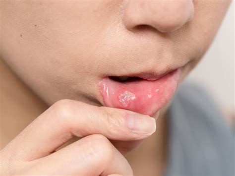 Mucocele: what is it, what types are there and how can it be cured?