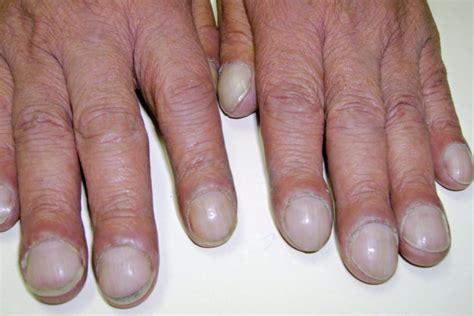 Clubbed Fingers and Nails: Causes and What They Look Like