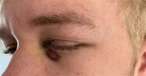 Teenager suffers fractured eye socket in 'unprovoked' attack on night ...