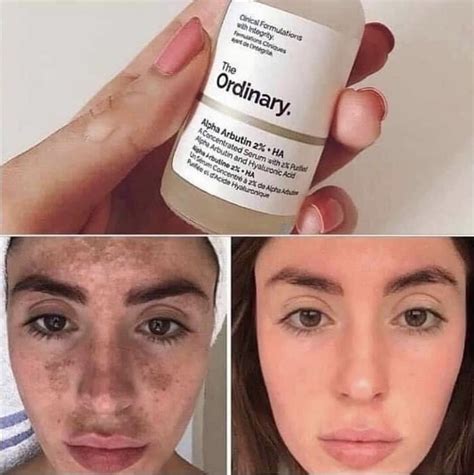 The Ordinary Alpha Arbutin Serum | Skin care routine, Natural skin care ...