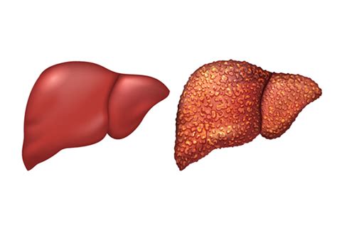 Liver Diseases: Disorders, Causes, Symptoms & Diagnosis - InlifeHealthCare