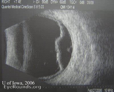 Atlas Entry - Choroidal Detachments