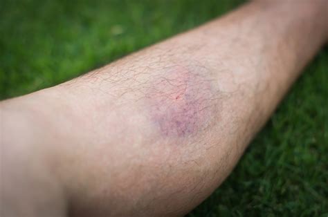 Does A Blood Clot Look Like A Bruise On Your Leg at Greg Yerkes blog