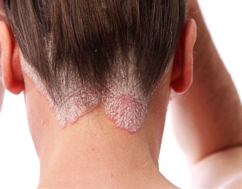 Psoriasis Vs. Eczema: How To Know Which One You're Dealing With - Mustela USA