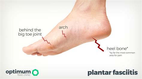 Plantar Fasciitis - Heel Pain Explained - Optimum Foot Clinic