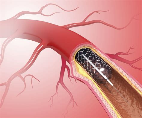 Cardiac Stent Mri Safety