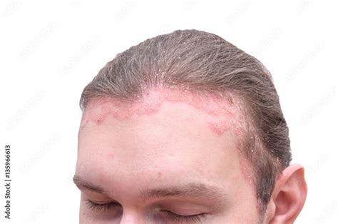 Eczema Forehead