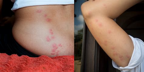 Bed Bug Bites Pictures, Symptoms: What Do Bed Bug Bites Look Like?