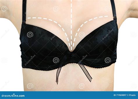 Marks on a Woman S Breast before Plastic Surgery Stock Image - Image of plastic, thin: 71969897