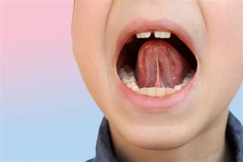 Frenectomy | Why It’s Needed and When | Fixing Your Frenum