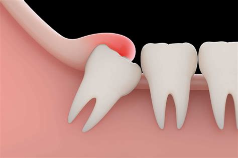 Wisdom Tooth Extraction Infection Prevention and Healing Tips - Booboone.com