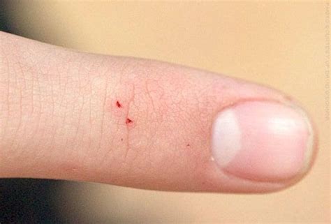 How To Identify The Most Common Bug Bites | Spider bites, Insect bites, Home health remedies