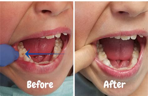 Dental Fillings / Cavity Treatment — Shanna Chirco DDS