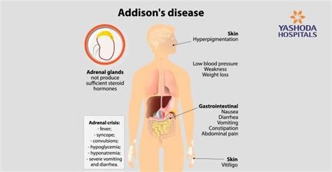 Adrenal Gland Disorders: Types, Causes, Symptoms, Diagnosis, Treatment and Complications