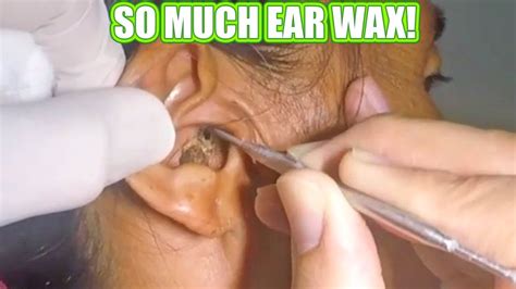 So MUCH Ear Wax! Almost Sick! Removal and Treatment - YouTube