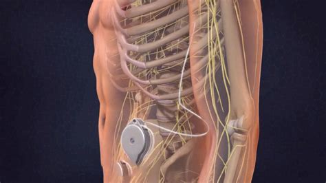 Pain pump, Intrathecal drug pump : Types , Pros and Cons – Thomas J. Hong, DO