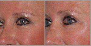 BOTOX AROUND EYES: Benefits, Before and After Results, Cost, Side Effects | The Cosmetic Skin Clinic