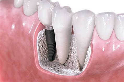 Bone Graft and Sinus Lift Services Offered - Starlight Dental Clinic