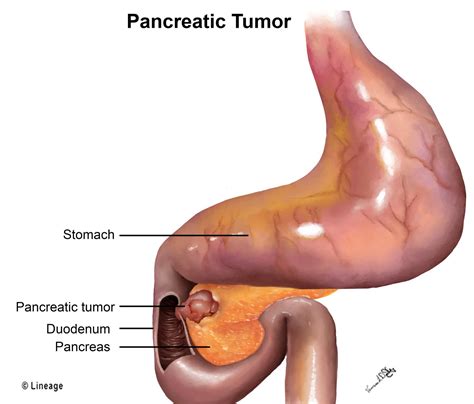 Pancreatic Cancer - USMLE Strike