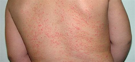 Prickly Heat Symptoms, Causes, Prognosis, Treatment | Prickly Heat Treatment | Pinterest | Heat ...