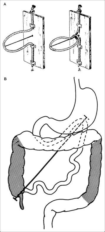 The changing spectrum of intestinal malrotation: diagnosis and ...