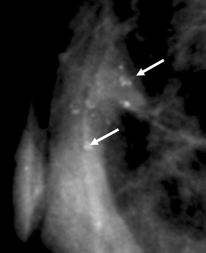 Common and Unusual Diseases of the Nipple-Areolar Complex | RadioGraphics