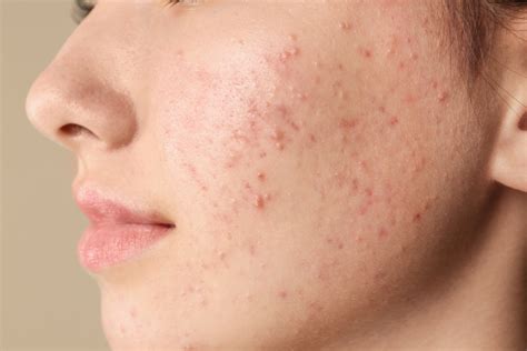 What is the Best Acne Treatment for Sensitive Skin? 4 Best Acne-Fighting Skincare Ingredients ...