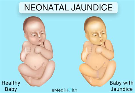 Glory Tips About How To Prevent Jaundice In Babies - Effectsteak33