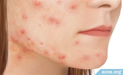 The Truth About "Chin Acne" In Women - Acne.org