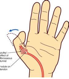 How to treat trigger thumb, from Oh My Arthritis Thumb Splint, Tendon