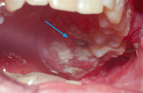 Oral cavity cancer, causes, symptoms, diagnosis, treatment & prognosis