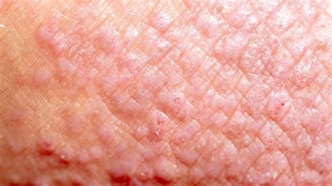 Types of Eczema: Contact Dermatitis | Gladskin