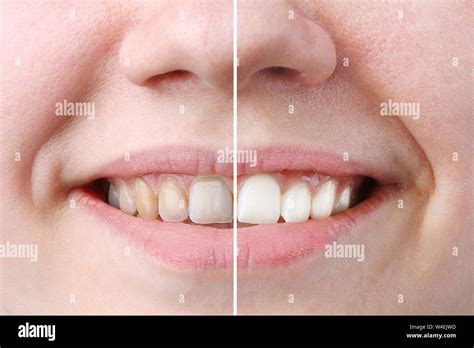 Skin bleaching before after hi-res stock photography and images - Alamy