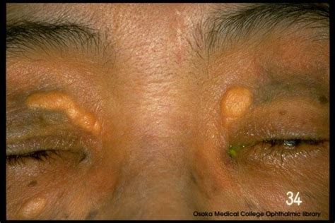 xanthoma-1 | Xanthelasma Removal